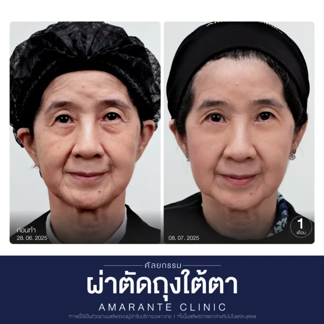 คุณดารุณีกับผลลัพธ์ที่ให้มากกว่าความประทับใจ ใต้ตาเรียบเนียน กลับมาดูอ่อนเยาว์อีกครั้ง