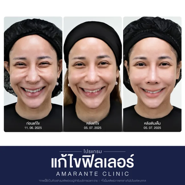 ผลลัพธ์หลังโปรแกรมฟิลเลอร์ใต้ตาของคุณคุณฟาง