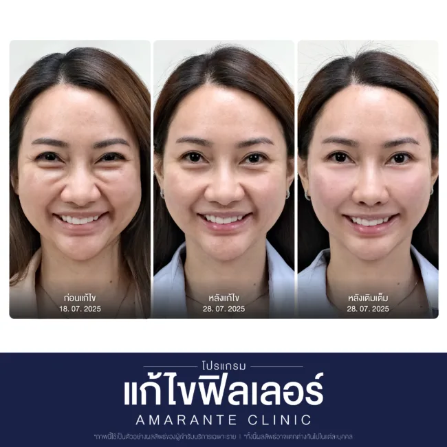 จบปัญหาหน้าล้น ใบหน้าดูสดใส BA คุณเนเน่