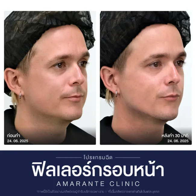 คุณแดนนี่ ก่อนและหลังทำ