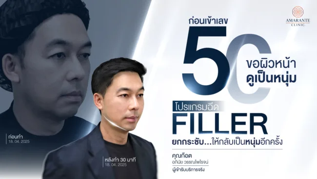 วิวฉีดฟิลเลอร์ยกหน้า คุณก๊อต อภินัย