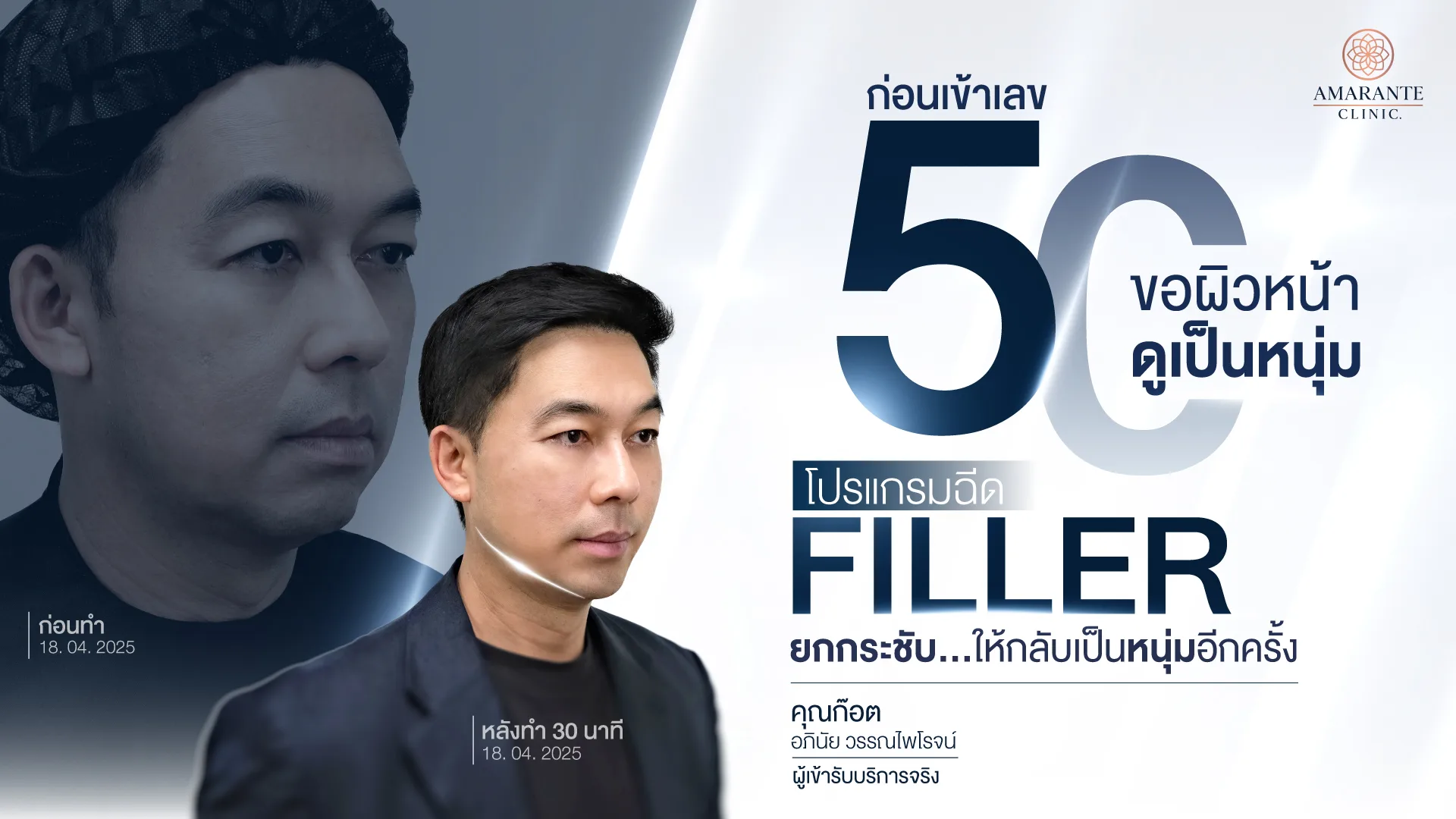 วิวฉีดฟิลเลอร์ยกหน้า คุณก๊อต อภินัย