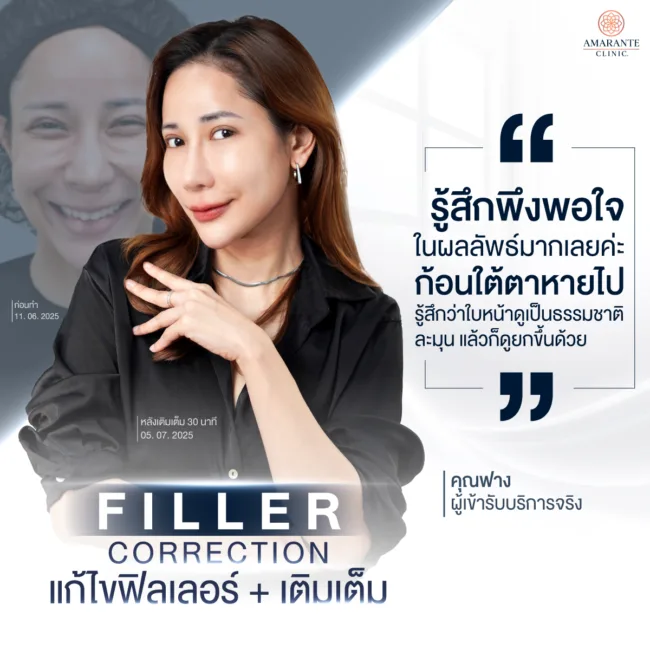 คุณหมอต้นแก้ไขใต้ตาเป็นก้อนด้วยฟิลเลอร์ใต้ตาและปรับหน้าแก้มผิดรูปให้คุณฟาง