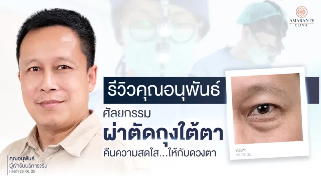 รีวิวผ่าตัดถุงใต้ตา คุณอนุพันธ์