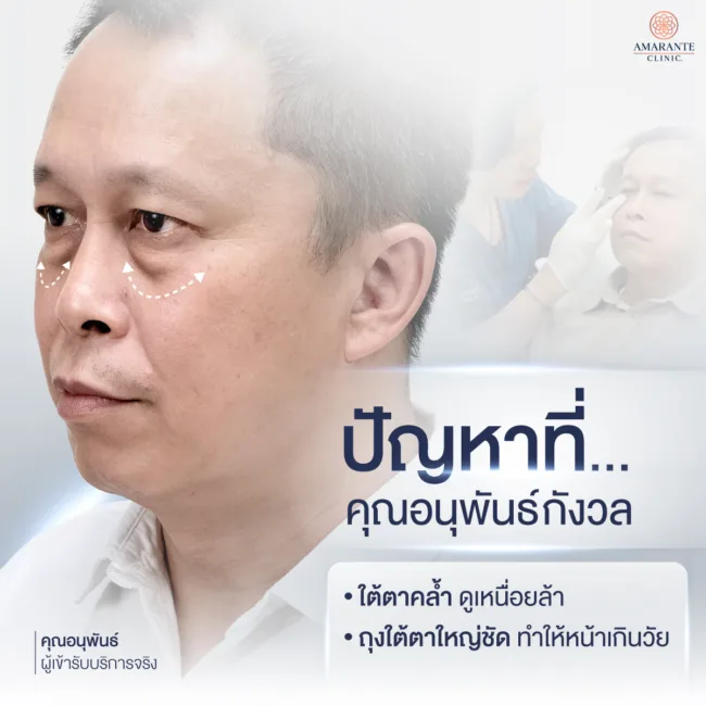 ปัญหาถุงใต้ตาบวมเป็นก้อนทำให้หน้าดูโทรมมีอายุของคุณอนุพันธ์
