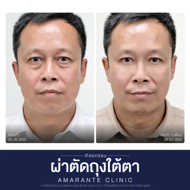 ผลลัพธ์หลังศัลยกรรมผ่าตัดถุงใต้ตาของคุณคุณอนุพันธ์