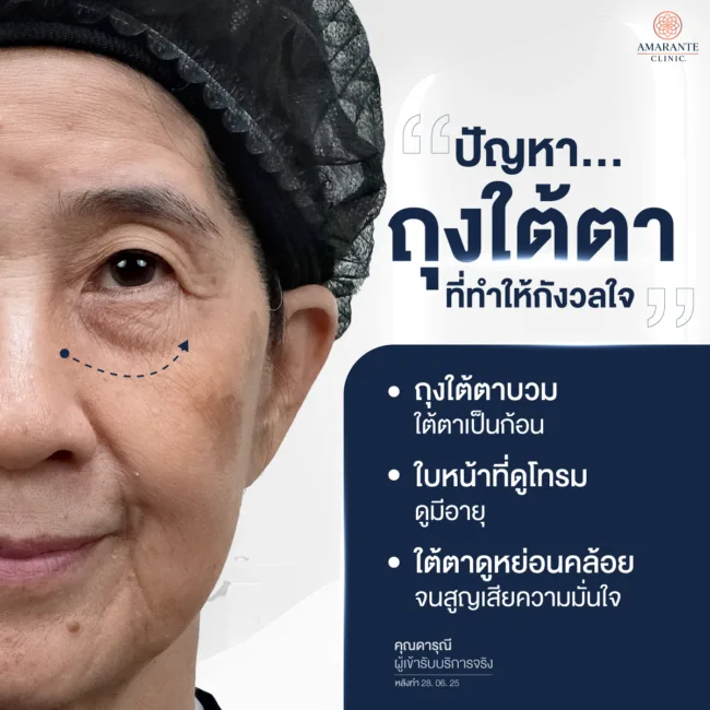 ปัญหาถุงใต้ตาหย่อนคล้อยในวัยสูงอายุของคุณดารุณี คุณแม่ของคุณนัท No Plan Trip