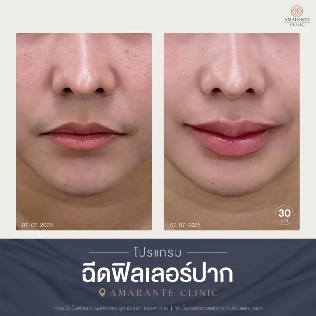 [บทความความรู้] รวมทุกเรื่องที่ควรรู้เกี่ยวกับฉีดฟิลเลอร์ปาก-05