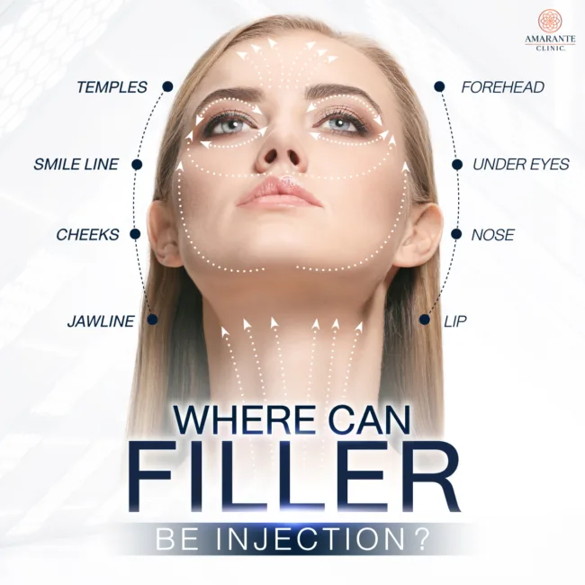 What Areas Can Be Treated with Fillers?