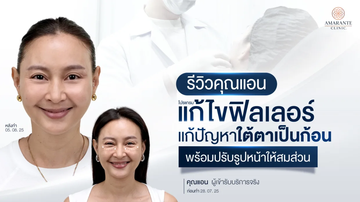 รีวิวคุณแอน แก้ไขฟิลเลอร์ แก้ปัญหาใต้ตาเป็นก้อน