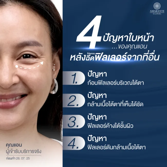 คุณแอนเขอปัญหาฟิลเลอร์เป็นก้อน อยากแก้ไขฟิลเลอร์