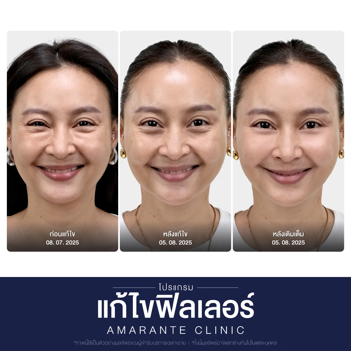ผลลัพธ์หลังทำแก้ไขฟิลเลอร์ และเติมเต็มใบหน้าใหม่ด้วยฟิลเลอร์ให้คุณแอน