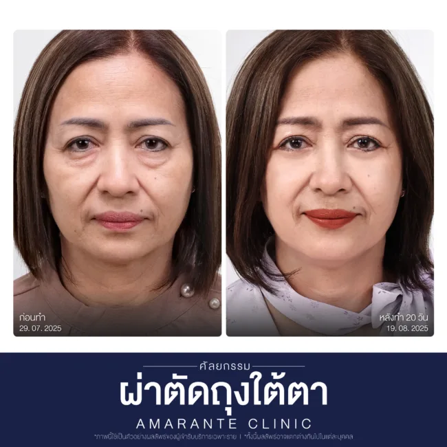 ผลลัพธ์หลังทำ BA คุณแก้วตา
