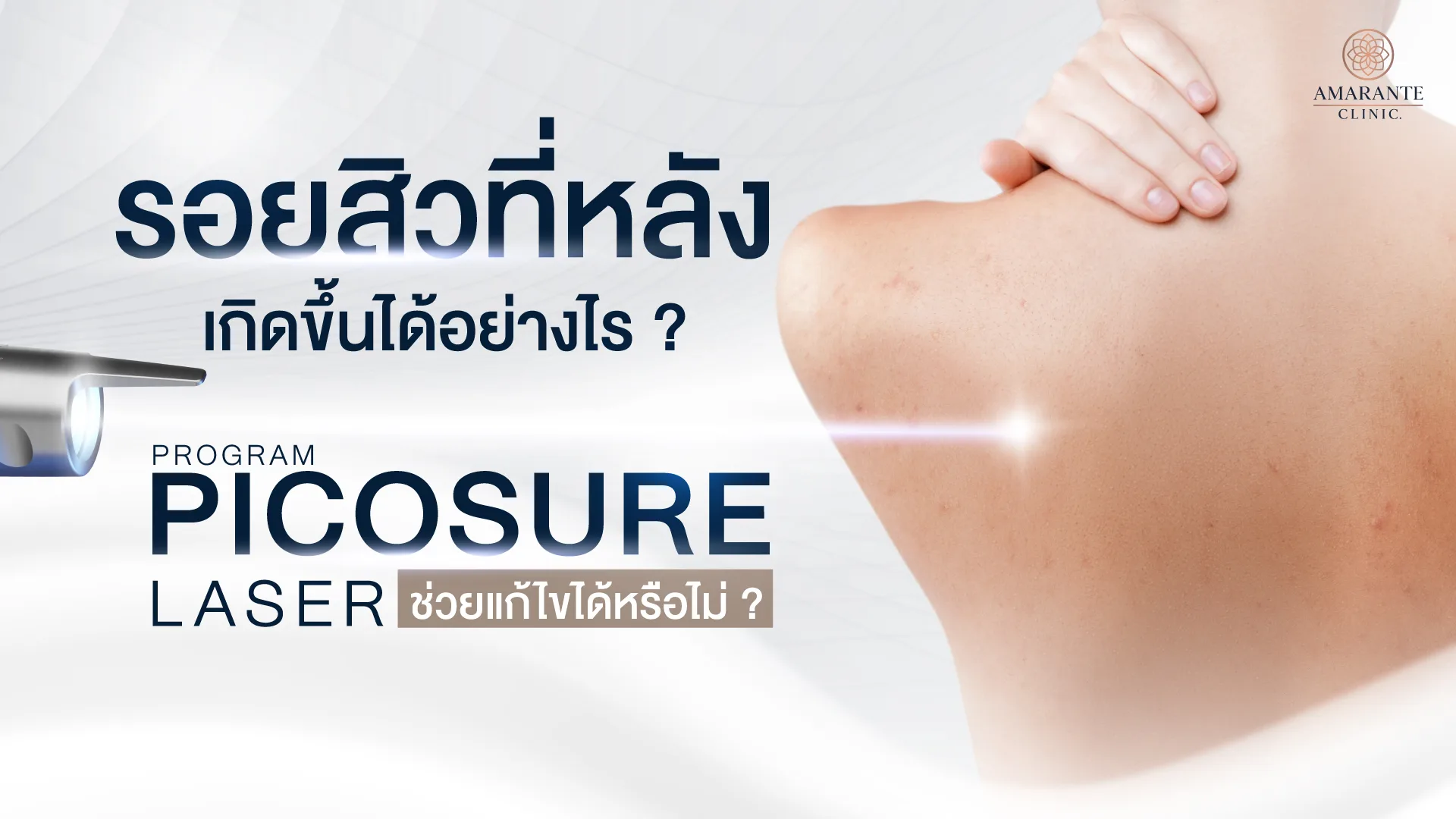 รอยสิวที่หลัง