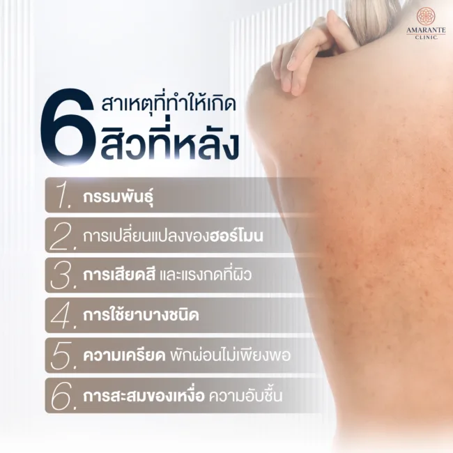 สิวที่หลังเกิดขึ้นได้ยังไง