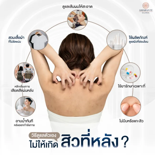 ดูแลตัวเองไม่ให้เกิดสิวที่หลัง