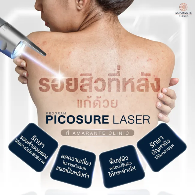 Picosure Laser ลบรอยสิวที่หลัง