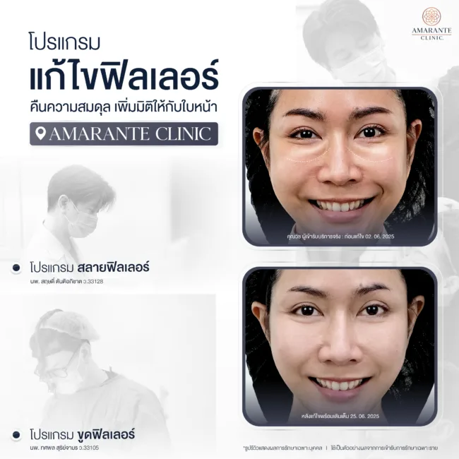 โปรแกรมแก้ไขฟิลเลอร์ที่ Amarante Clinic