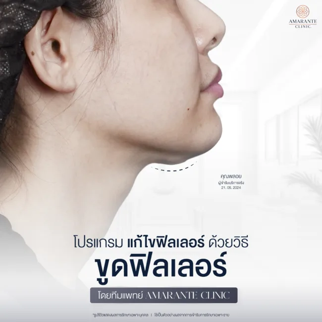 โปรแกรมขูดฟิลเลอร์