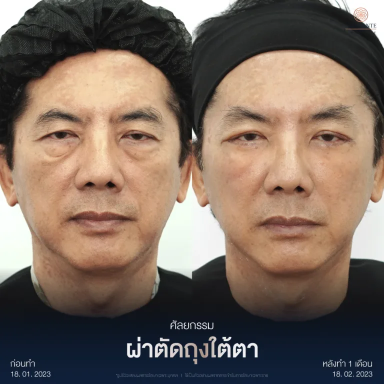ผ่าตัดถุงใต้ตา