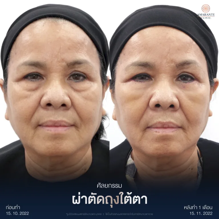 ผ่าตัดถุงใต้ตา