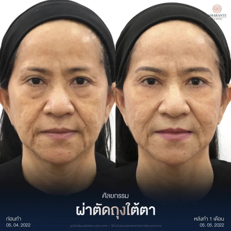 ผ่าตัดถุงใต้ตา