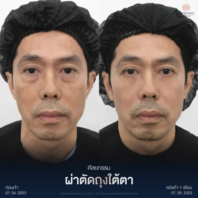 ผ่าตัดถุงใต้ตา