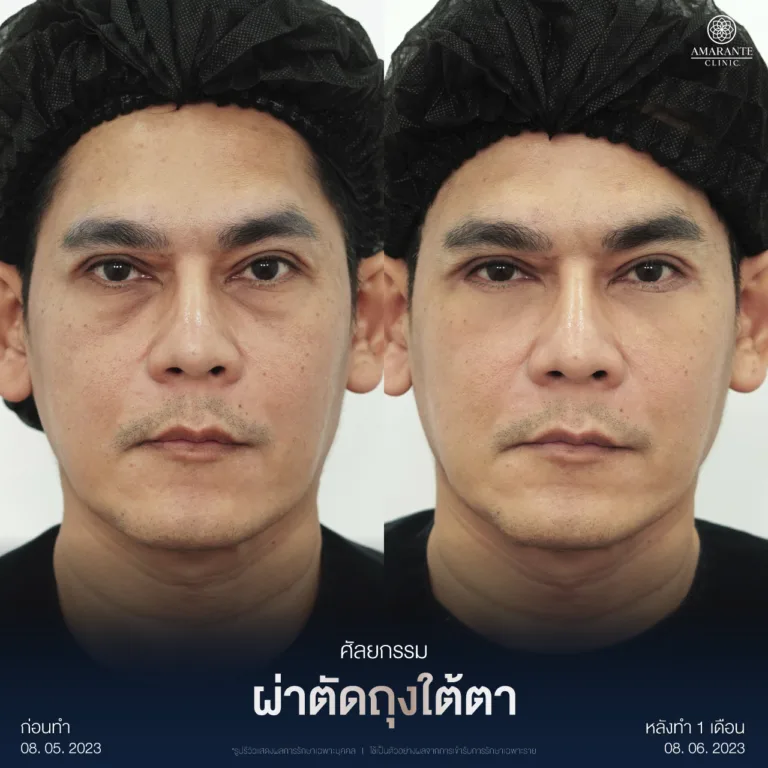 ผ่าตัดถุงใต้ตา