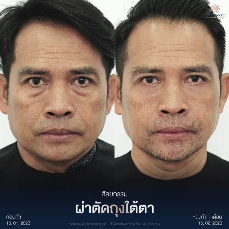 ผ่าตัดถุงใต้ตา