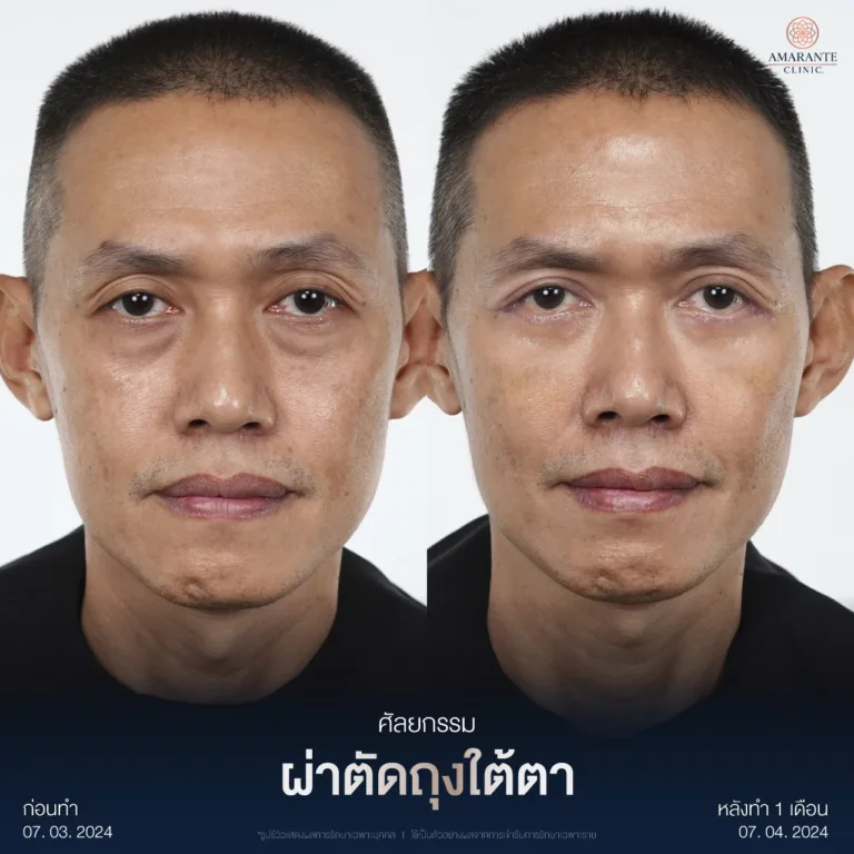 ผ่าตัดถุงใต้ตา