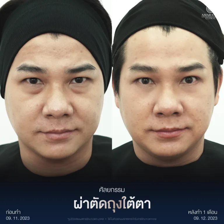 ผ่าตัดถุงใต้ตา