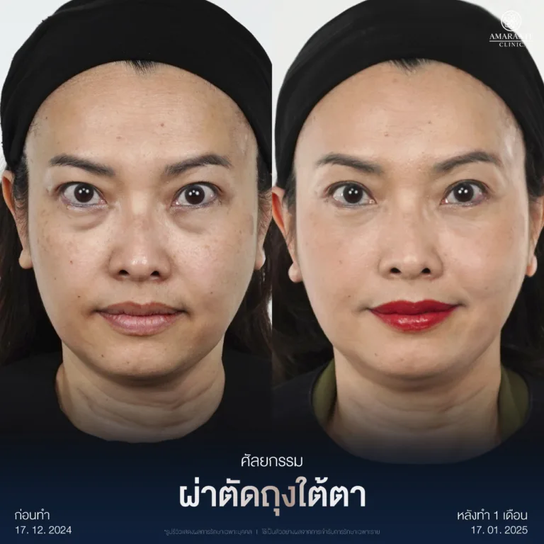 ผ่าตัดถุงใต้ตา