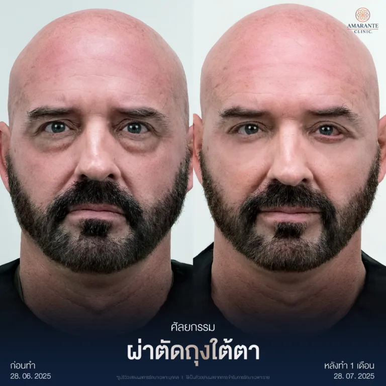 ผ่าตัดถุงใต้ตา