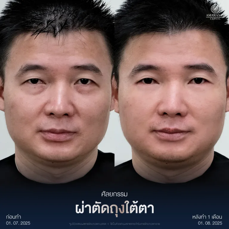 ผ่าตัดถุงใต้ตา