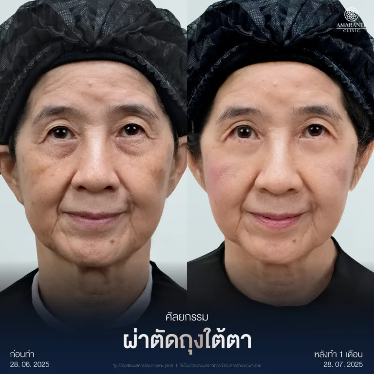 ผ่าตัดถุงใต้ตา