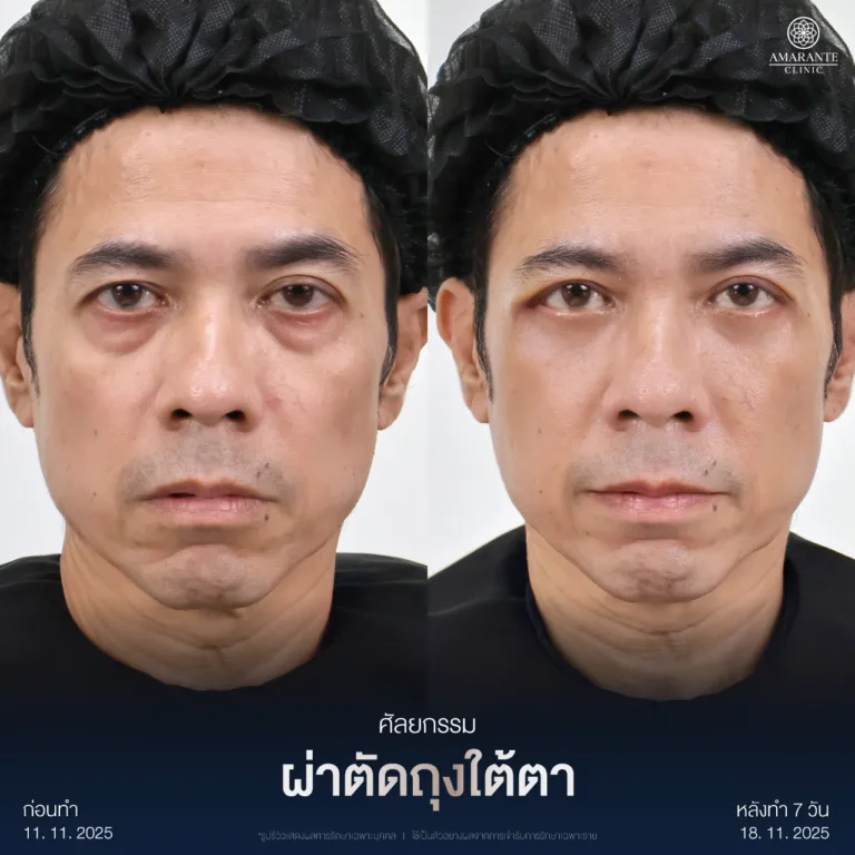 ผ่าตัดถุงใต้ตา