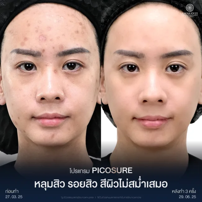 ภาพรีวิวก่อนหลังทำPicosure Pro