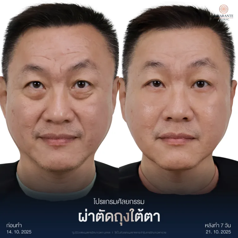 ผ่าตัดถุงใต้ตา