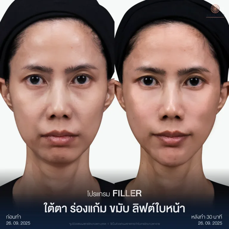 New-BA-ฟิลเลอร์-คุณกนกวรรณ-01