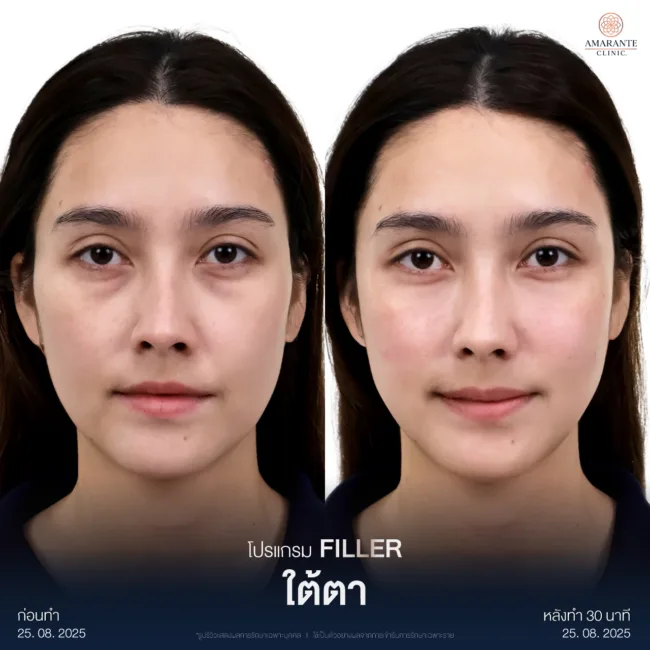 รีวิวก่อนหลังฉีดฟิลเลอร์ใต้ตา