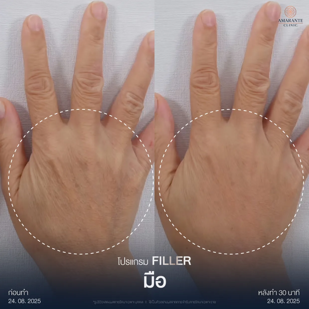 รีวิวฉีดฟิลเลอร์มือ