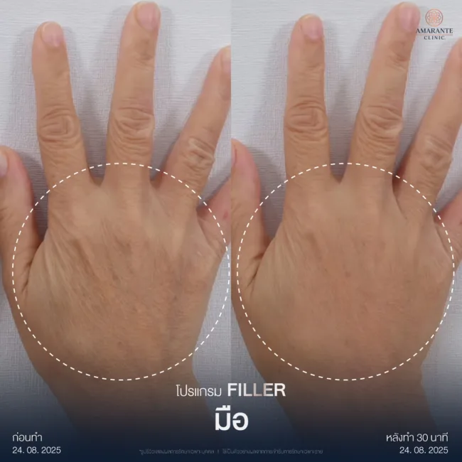 รีวิวฉีดฟิลเลอร์มือ