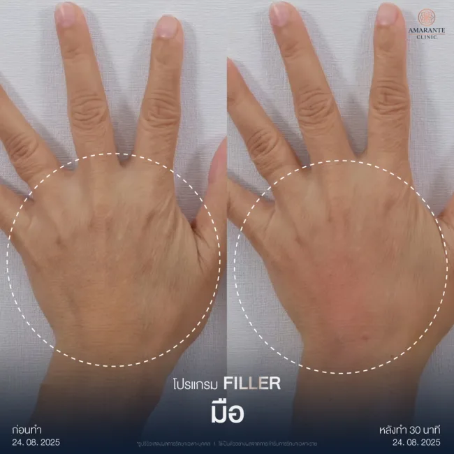 รีวิวฉีดฟิลเลอร์มือ1