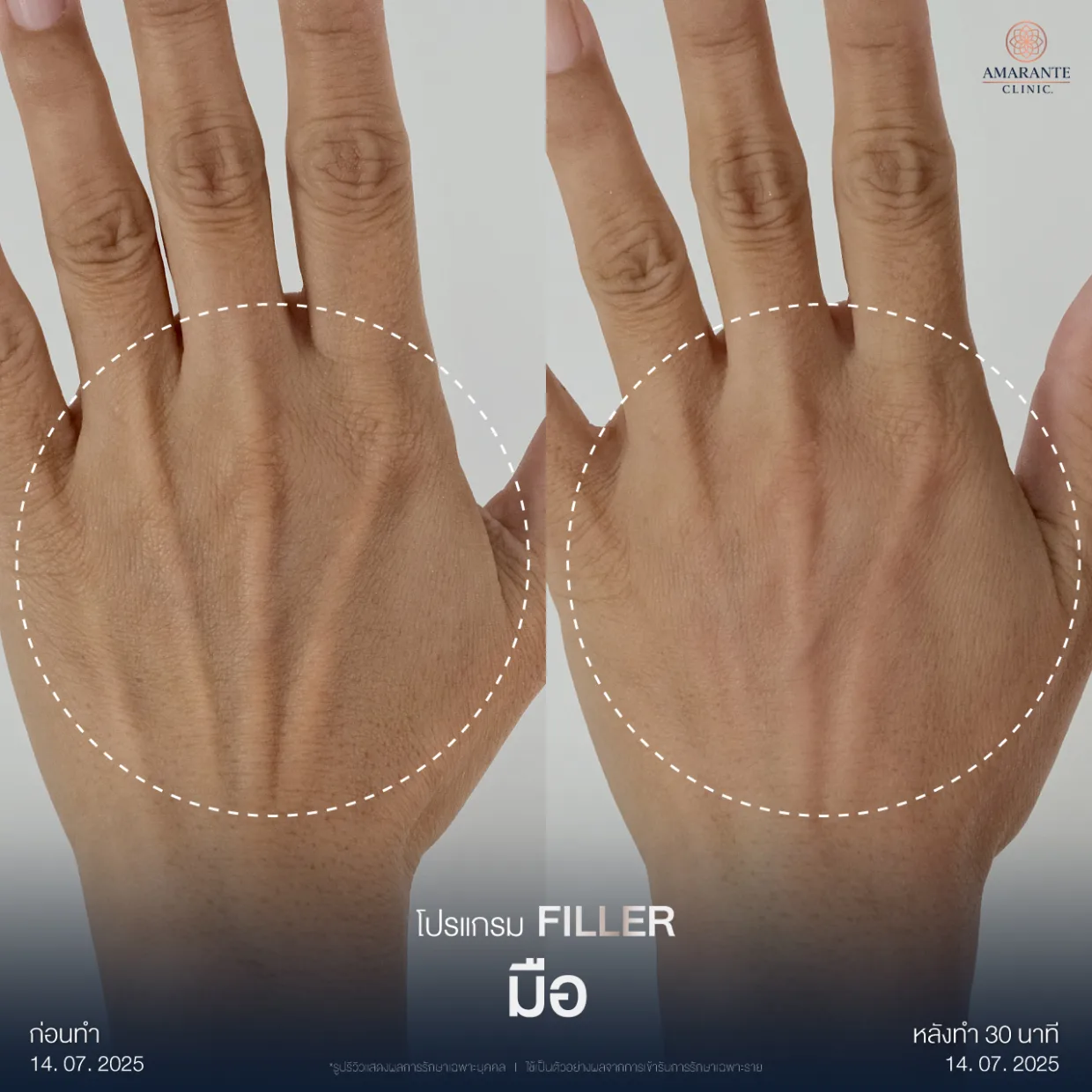 รีวิวฉีดฟิลเลอร์มือ2