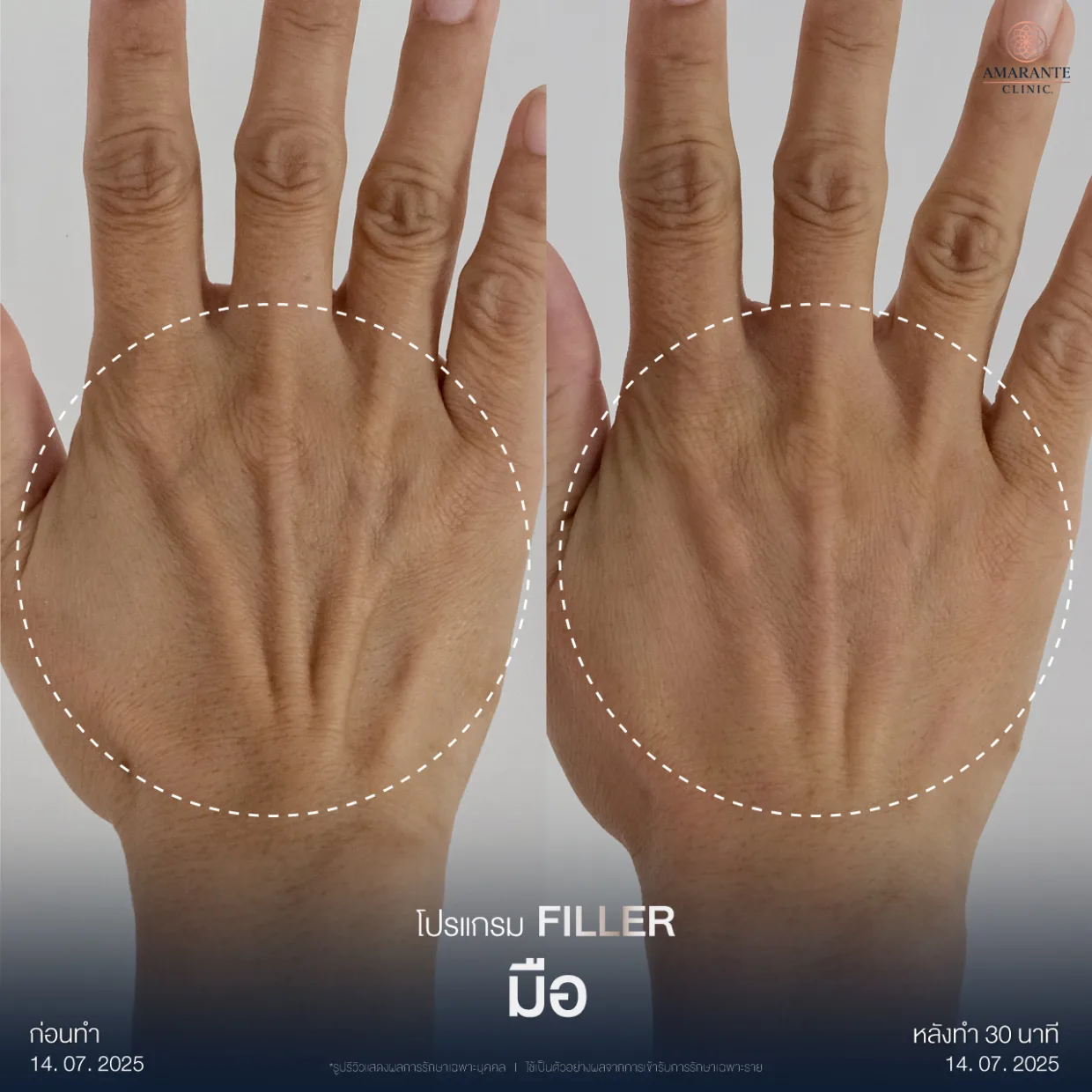 รีวิวฉีดฟิลเลอร์มือ3