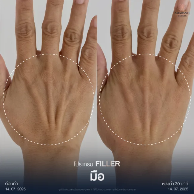 รีวิวฉีดฟิลเลอร์มือ3