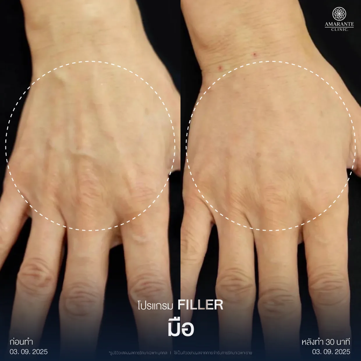 รีวิวฉีดฟิลเลอร์มือ4