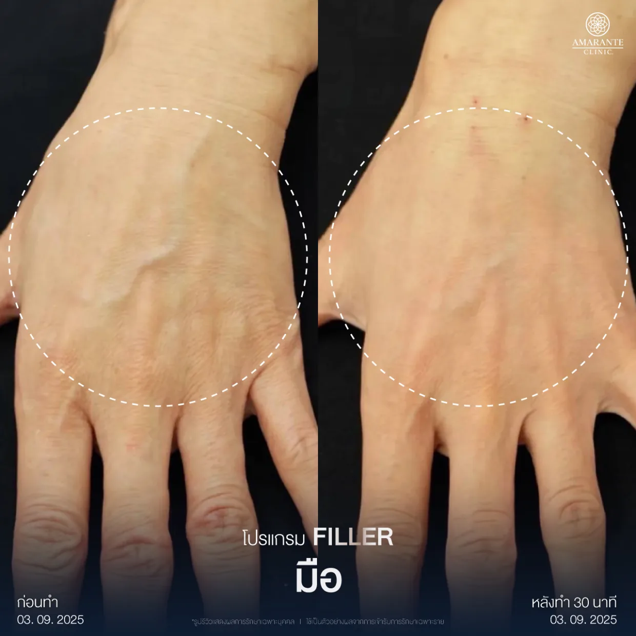 รีวิวฉีดฟิลเลอร์มือ5