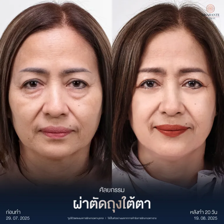 ผ่าตัดถุงใต้ตา