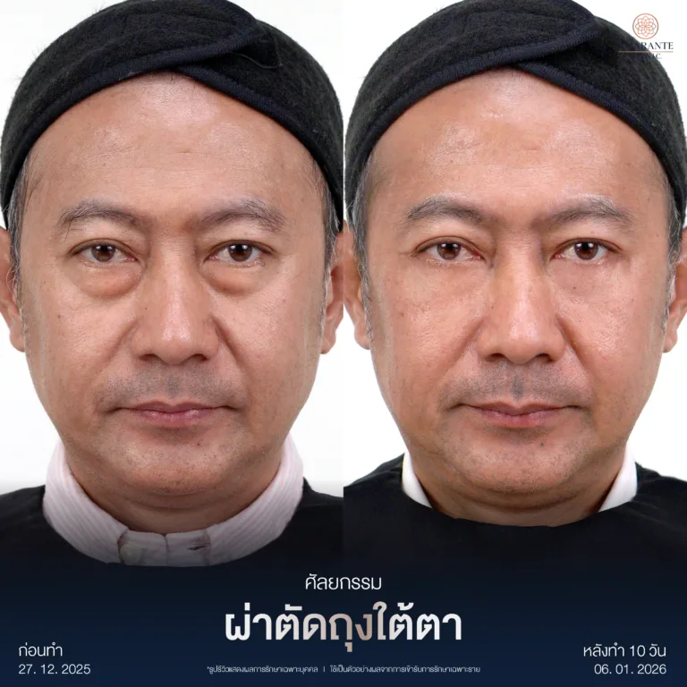 ผ่าตัดถุงใต้ตา
